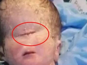one eye kid