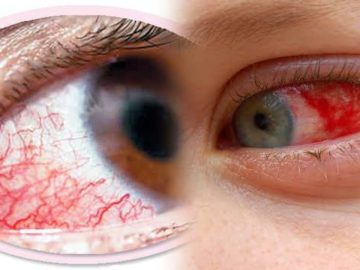 Reason Behind Pink Eye