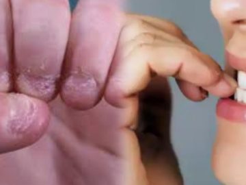 Nailbitting Obsessive Compulsive Disorder