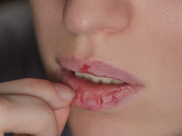 Dry lips causes and remedy