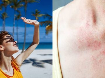 Summer Skin Diseases Infection