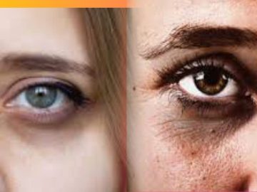 Dark Circle Under Eyes