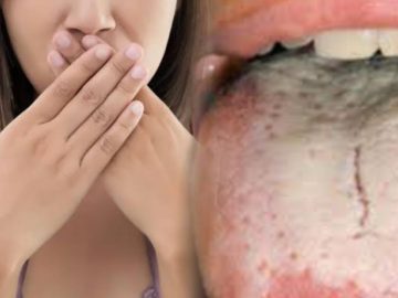 Tongue And Bad Breath